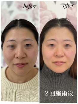 リローゼ(Re.ROSE)/トーンアップ&リフトアップ