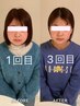 【劇的小顔術・最高レベル】超音波リフト全顔＋首＋ヘッドスパ＋パック