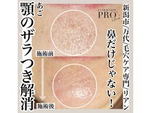 リアン(Riant)/毛穴ケアコース 