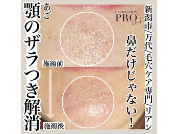 リアン(Riant)/毛穴ケアコース