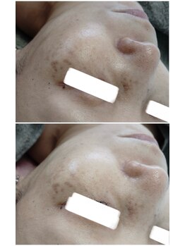 ビーユー(Be.you)/ダクトピーリング1回の効果