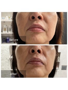 ココル(COCORU)/目指せ！白雪肌☆スノーピール