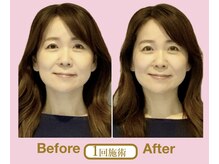 アニュームーン 草津エイスクエア店(aNewMoon)/小顔矯正/ビフォーアフター