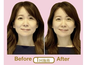 アニュームーン 草津エイスクエア店(aNewMoon)/小顔矯正/ビフォーアフター