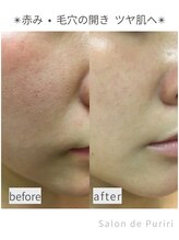 サロン ド プリリ(Salon de Puriri)/毛穴、赤み、繰り返す肌荒れ