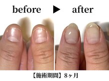 リング ザ ベル(ring the bell)/深爪スタンダードコース¥11,000