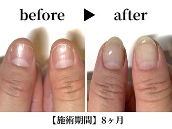 リング ザ ベル(ring the bell)/深爪スタンダードコース¥11,000