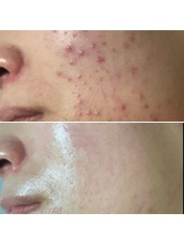 ルミアリュクス(LUMIA LUXE)/頑固なニキビでお悩みの方