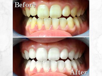 LBSホワイトニング 銀座店/セルフホワイトニングの症例写真