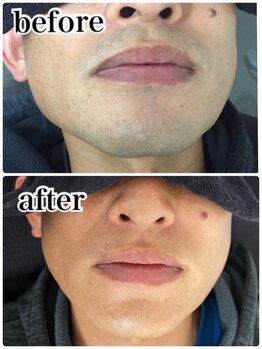 エアリアル 中津店/髭脱毛