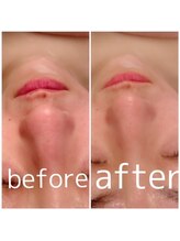 アンリール 旭川店(Anrire)/フェイシャル施術のお客様です！