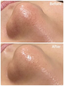 ハチ シンス 2023-(hachi-since 2023-)/【毛穴洗浄】　Before・After