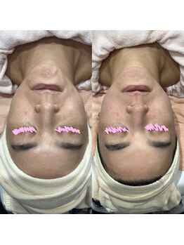 じゅえる/プラチナエステの効果