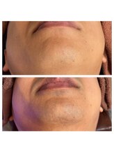 プルメリア(Plumeria)/脱毛開始半年経過