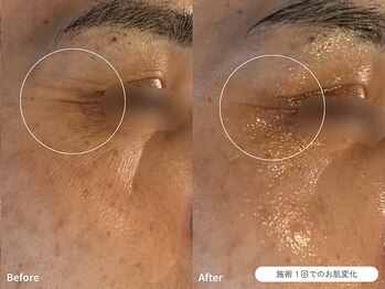 フォンビューティー(fon beauty)/年齢しわケア1回