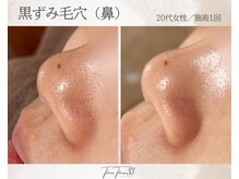 スリースリー 恵比寿(THREE THREE)/毛穴角栓・毛穴黒ずみ・毛穴開き