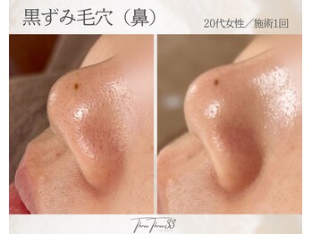 スリースリー 恵比寿(THREE THREE)/毛穴角栓・毛穴黒ずみ・毛穴開き