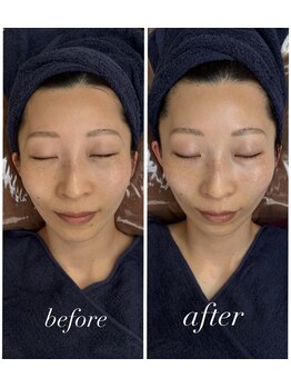 ソルテケア(SORTE*care)の写真/ほうれい線・たるみ・ハリ不足に。結果を重視した本格フェイシャルで、年齢を感じさせないハリ肌へ♪