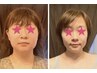 【小顔矯正】+【小顔マシーン】大人気のコラボ★通常￥20900