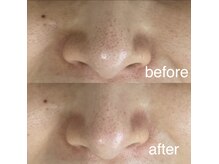 サロン ド ソワン(salon de soin)/毛穴エクストラクション・ハーブ