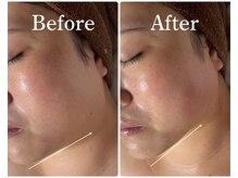 【半永久的小顔造形】県内初★脂肪分解美容液導入！