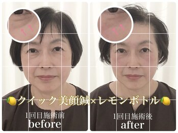 アキュモンド 渋谷院(acumond)/若見えUP◆60代たるみ・くま変化