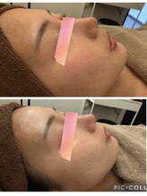 イディアル(IDE'AL)/陶肌トリートメント