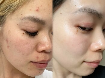 エステティック リベル キョウト 京都駅前店(Esthetic Liber Kyoto)の写真/自信をなくしがちな肌荒れ悩みに。肌質改善ピーリングで素肌を格上げ◎メイクのりまでアップ♪