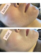 エスデザイン(es design)/毛穴レス肌／鹿児島／谷山エステ