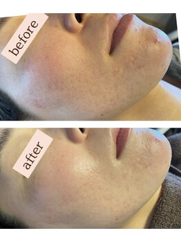 エスデザイン(es design)/毛穴レス肌/鹿児島/谷山エステ