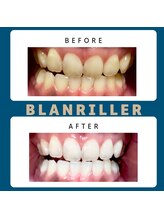 ブランリエ 天王寺阿倍野店(BLANRILLER)/ホワイトニング圧倒的効果実感♪