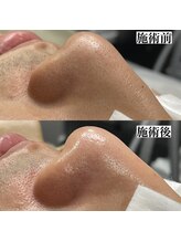 メンズー(MENZOO)/毛穴クリーンケア