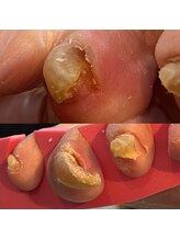 ウェルズユキ(well's yuki)/爪甲湾曲　爪が切れない