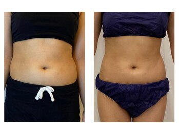 医療提携サロン/ボディ施術　ビフォー＆アフター