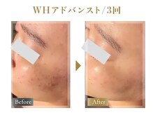 《ミコステラ/WHアドバンスト3回》ニキビにお悩みの方にも◎