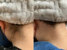 エビアス 旭川豊岡(evias)/レディース店　うなじ脱毛