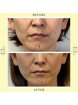 シスタス(Cistus)/【ExoLift】ビフォーアフター