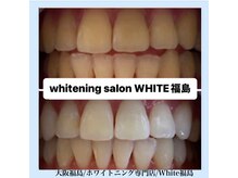 ホワイトニングサロン ホワイト(WHITE)/セルフホワイトニング/大阪/福島