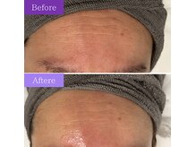 フェイシャルケア1回で額のシワも改善♪柔和な印象に