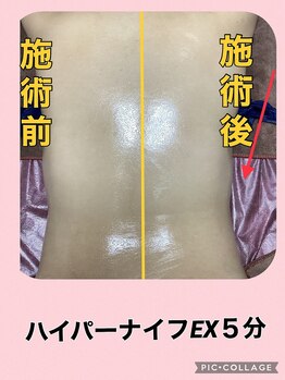 リヘッド(Re.head)/ハイパーナイフEX ウエスト集中