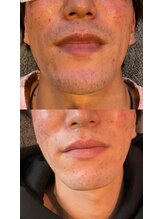 メンズサロン エイチ(H)/人気な髭脱毛