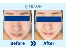 ストラッシュ 草津駅前店/施術例：小鼻