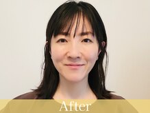 アントルーチェ 代々木上原(Entluce.)/美容鍼との組み合わせで相乗効果