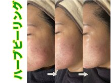 ブレア(Blair)/漢方ハーブピーリング