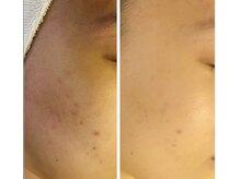 リム ビューティー(RYM BEAUTY)/思春期ニキビにもダクトピール