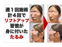 ボディアーキ 吉祥寺店(BODY ARCHI)/リフトアップ　たるみ　顔施術