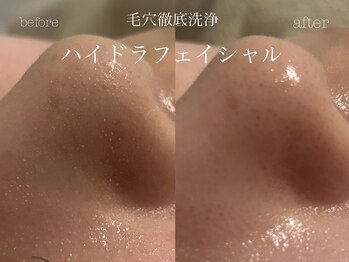 キアラ(CHIARA)/ハイドラフェイシャル