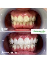 ホワイトニングサロン 名古屋駅店/【ホワイトニング施術例】