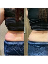 ビュウナ 銀座(BEAUNA)/脂肪冷却/frozen8