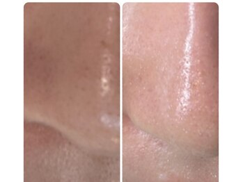 ラヴィエール(Laviere)/【ハイドロピーリング】